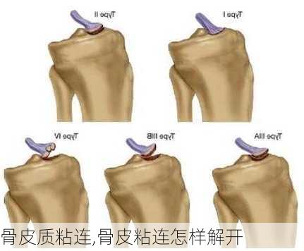 骨皮质粘连,骨皮粘连怎样解开