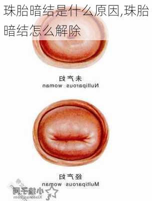 珠胎暗结是什么原因,珠胎暗结怎么解除