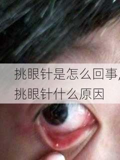 挑眼针是怎么回事,挑眼针什么原因